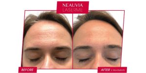 Nowoczesny laser Laser Me od Neauvia w Gabinecie Hebe