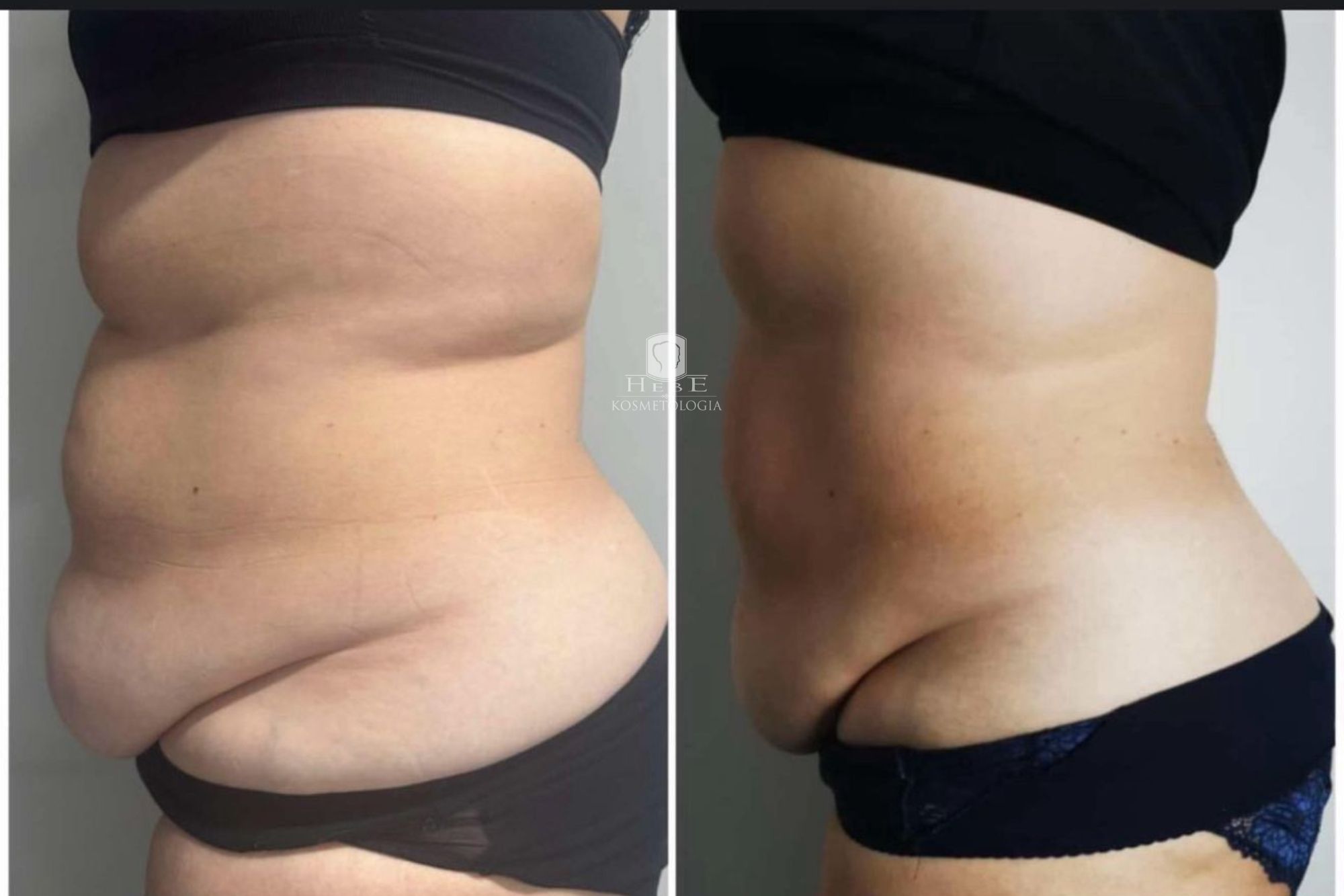 Najnowocześniejszy zabieg w Mławie!