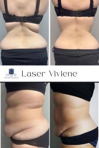 Kobieta przed i po zabiegu liposukcji laserowej. Zobacz efekty modelowania sylwetki.