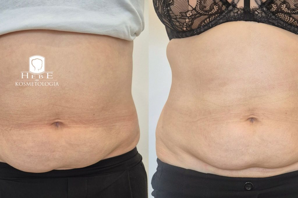 efekty zabiegu vivien w gabinecie hebe w mławie