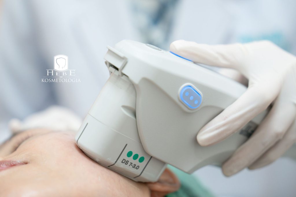 jak wygląda zabieg HIFU Młąwa