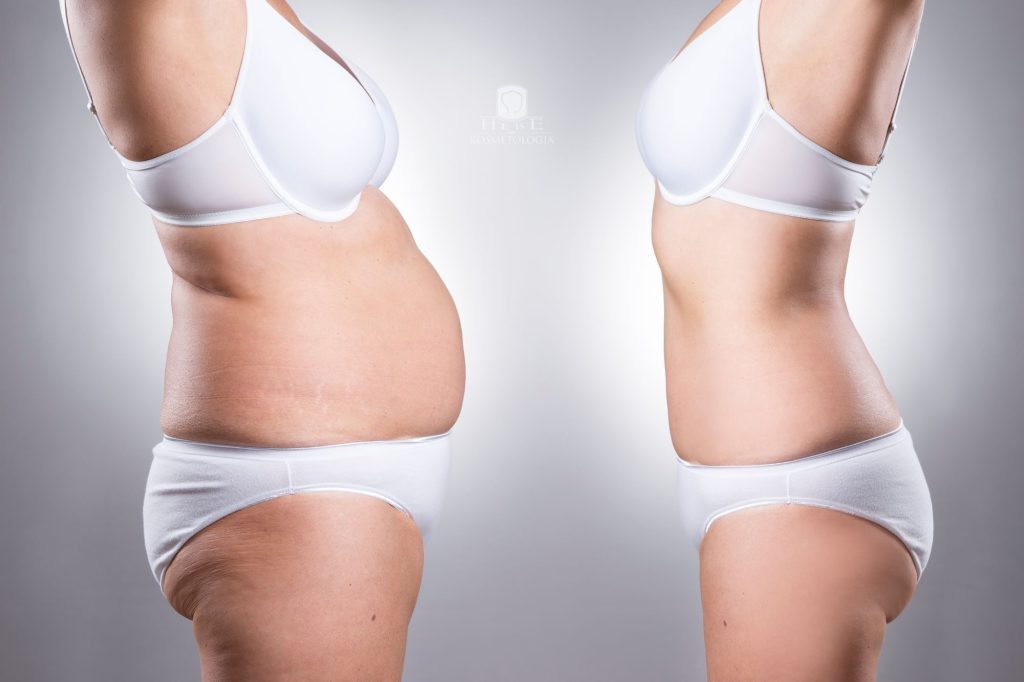 jak utrzymać efekty liposukcji laserowej?