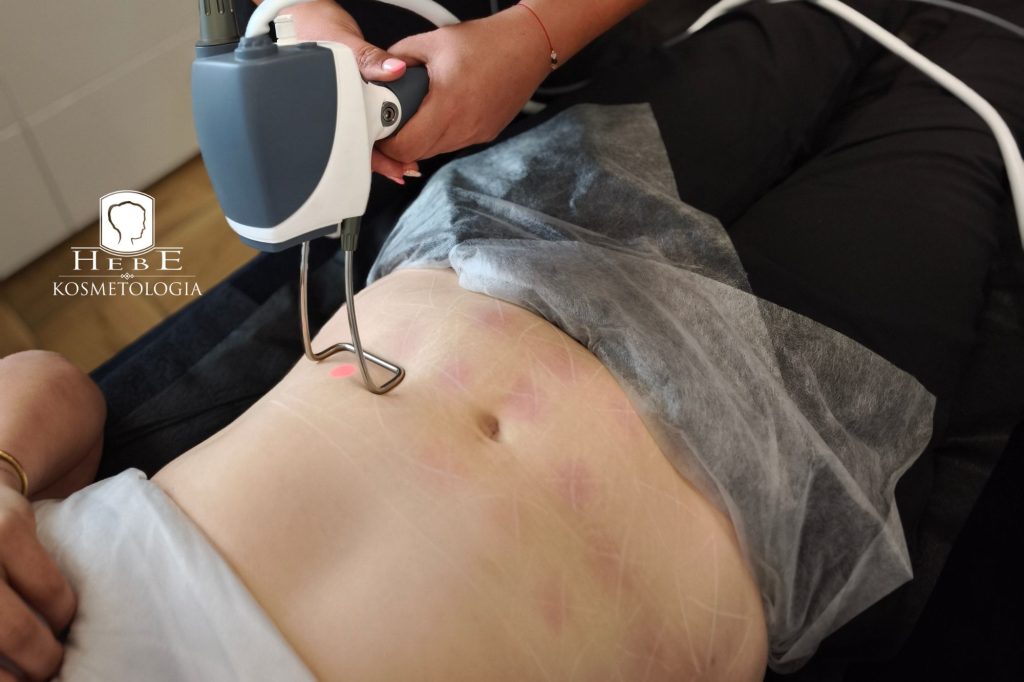 Urządzenie Vivien 1064 nm w Gabinecie Hebe w Mławie.