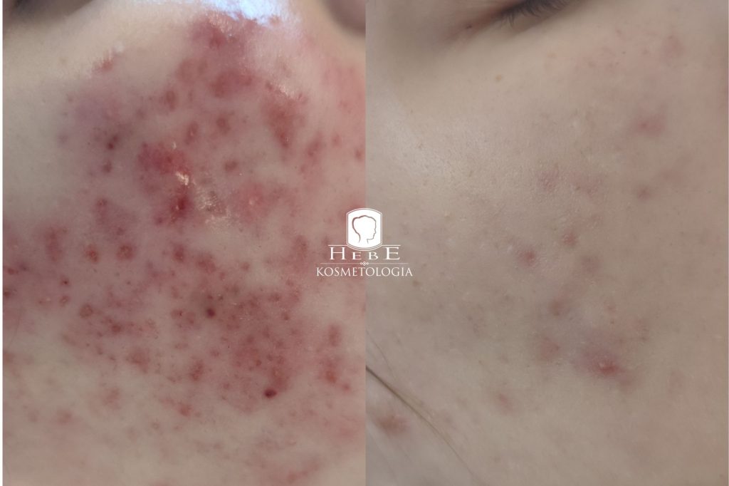 Skóra przed i po terapii trądziku