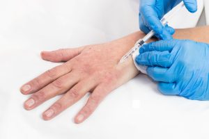 Dłonie podczas zabiegu mezoterapii igłowej. Ujędrnianie skóry dłoni.