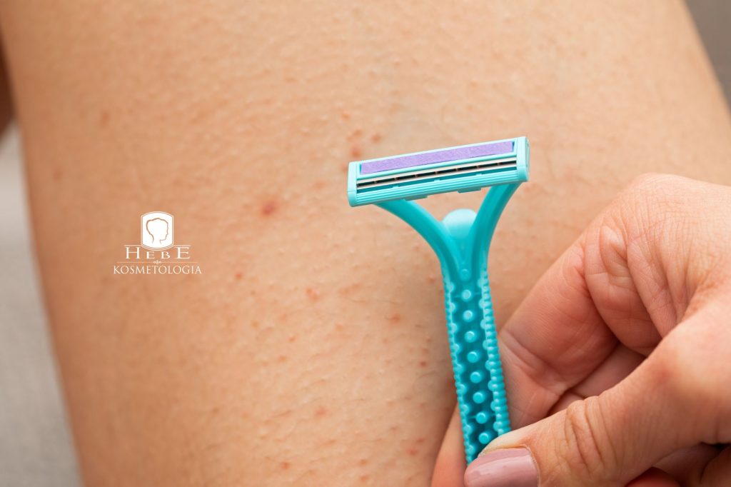 zapalenie mieszków włosowych i wrastające włoski na nodze