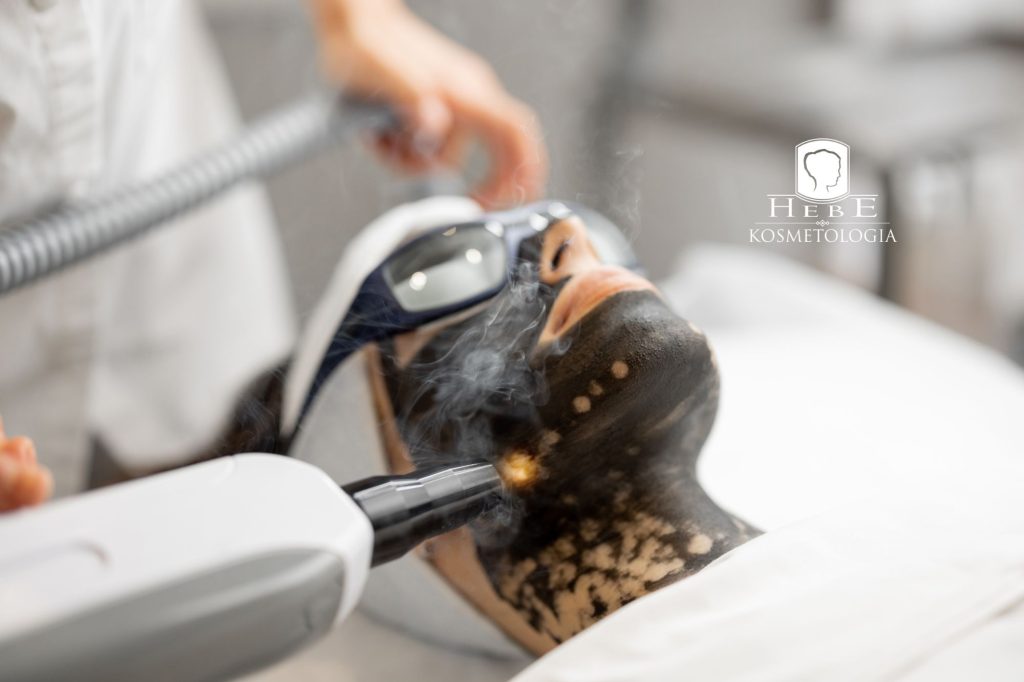 Laserowe odparowanie maski węglowej podczas zabiegu Black Doll Peel w Mławie.