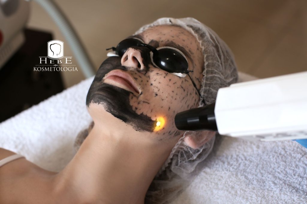 Maska węglowa na twarzy klientki przed zabiegiem Black Doll Peel.