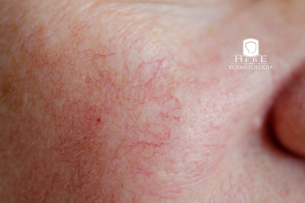 skóra naczynkowa skuteczna terapia