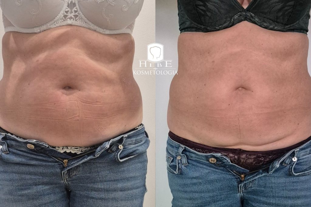 Efekt po 3 zabiegach modelowania sylwetki Mława laserem Vivien